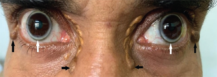 Corneal arcus (white arrows) along with cholesterol xanthomas (black arrows) in both eyes.